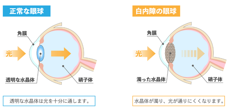 白内障