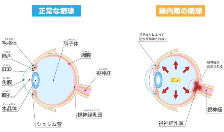 緑内障