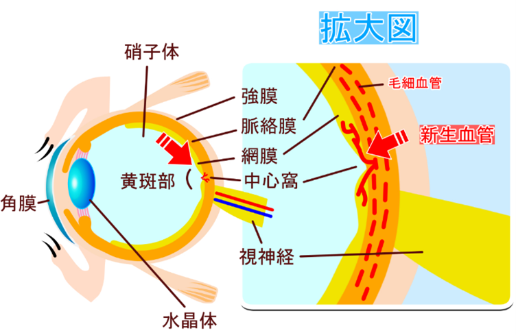 加齢黄斑変性