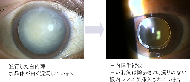 白内障手術について