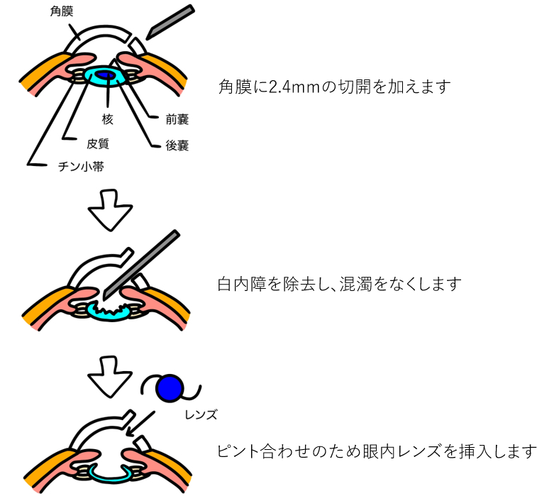 白内障手術について